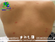 اعراض بق الفراش